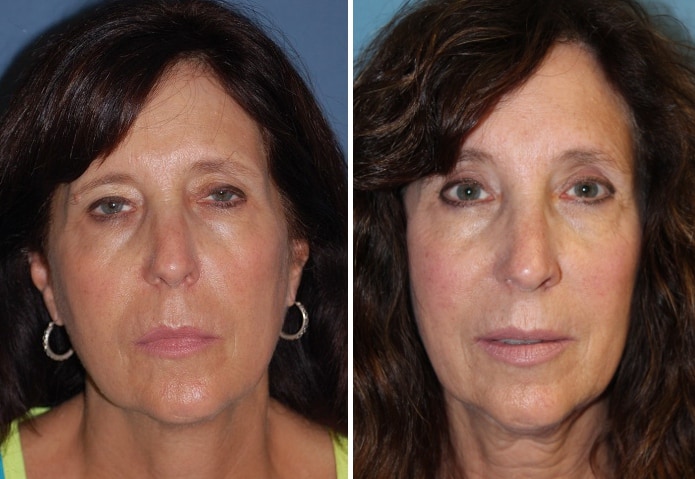 Brow Lift Surgery Before & After in San Diego & La Jolla