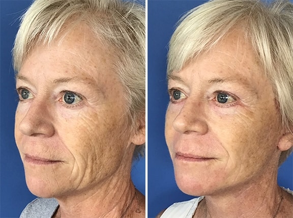 Necklift Patient Results before and after in San Diego