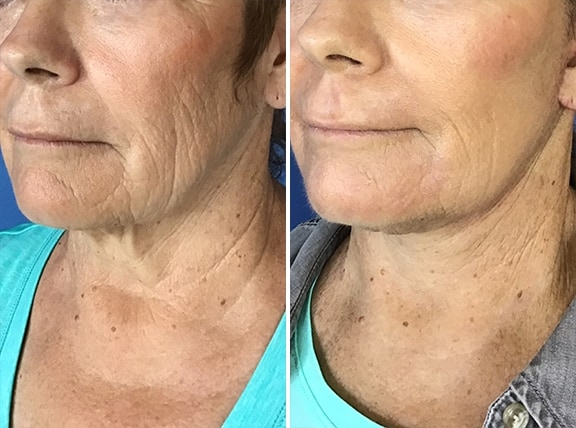 Necklift Before and After Photo in San Diego