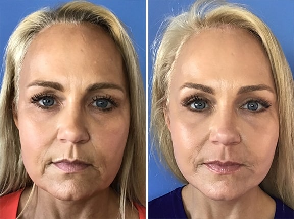 Facelift Patient Photos in San Diego