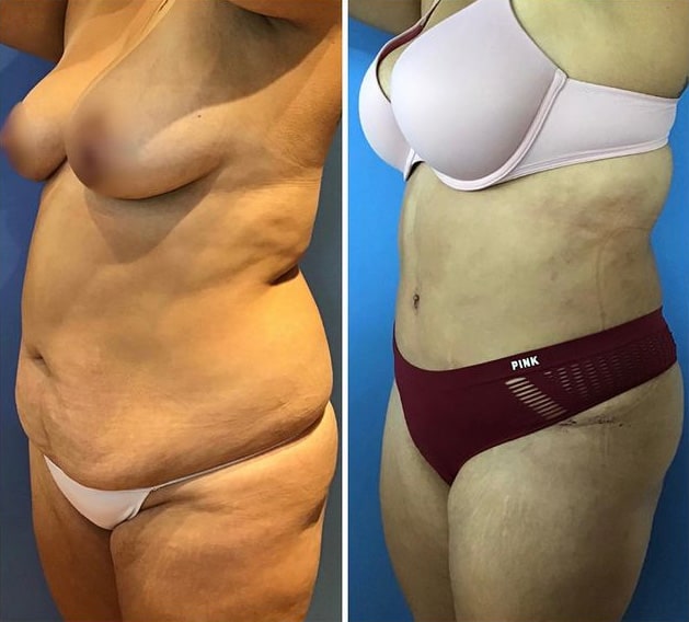 Liposuction before and after in San Diego & La Jolla