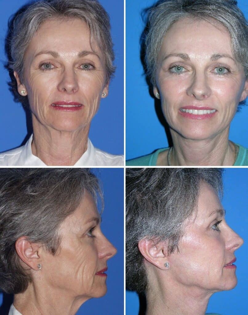 Facelift surgery San Diego. 