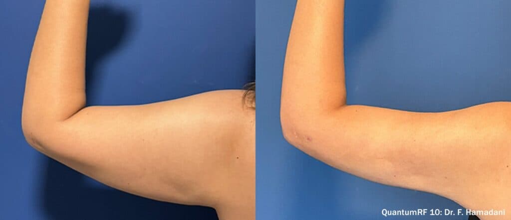 Arms Skin Tightening San Diego