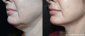 Jawline Skin Tightening San Diego
