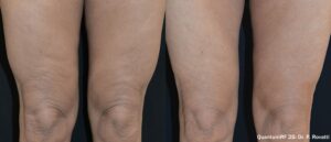 Knees Skin Tightening San Diego