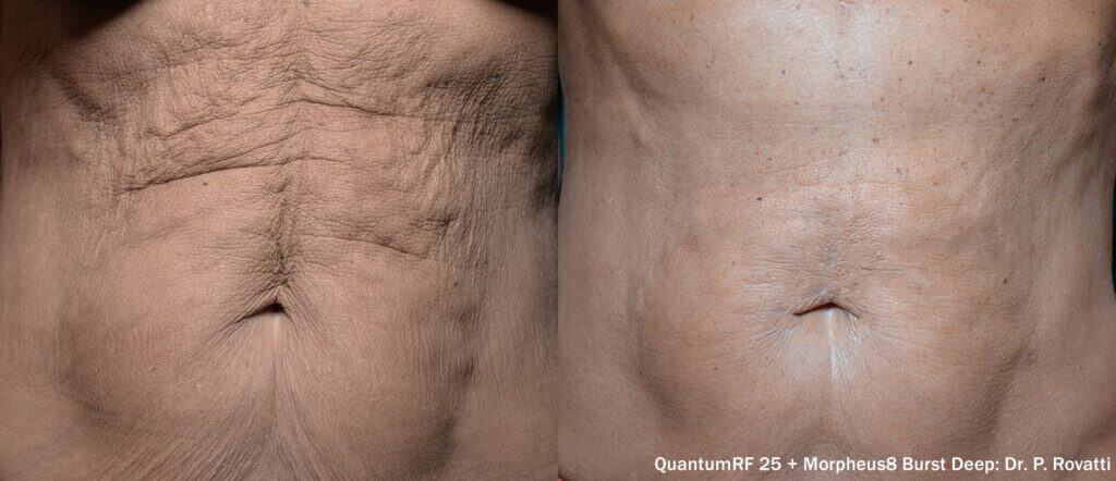 Tummy Skin Tightening San Diego