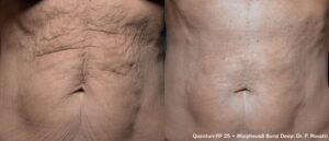 Tummy Skin Tightening San Diego