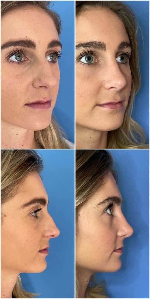 rhinoplasty before after san diego