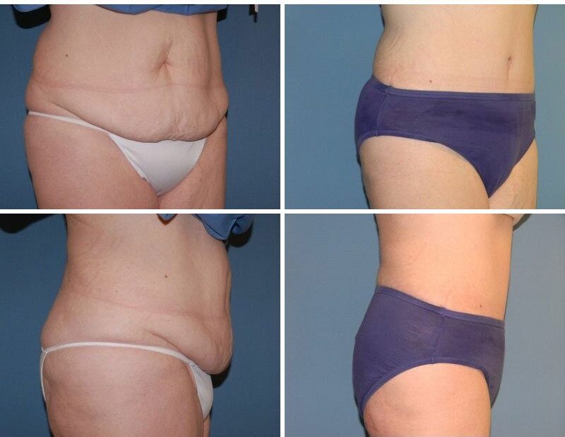 tummy tuck San Diego