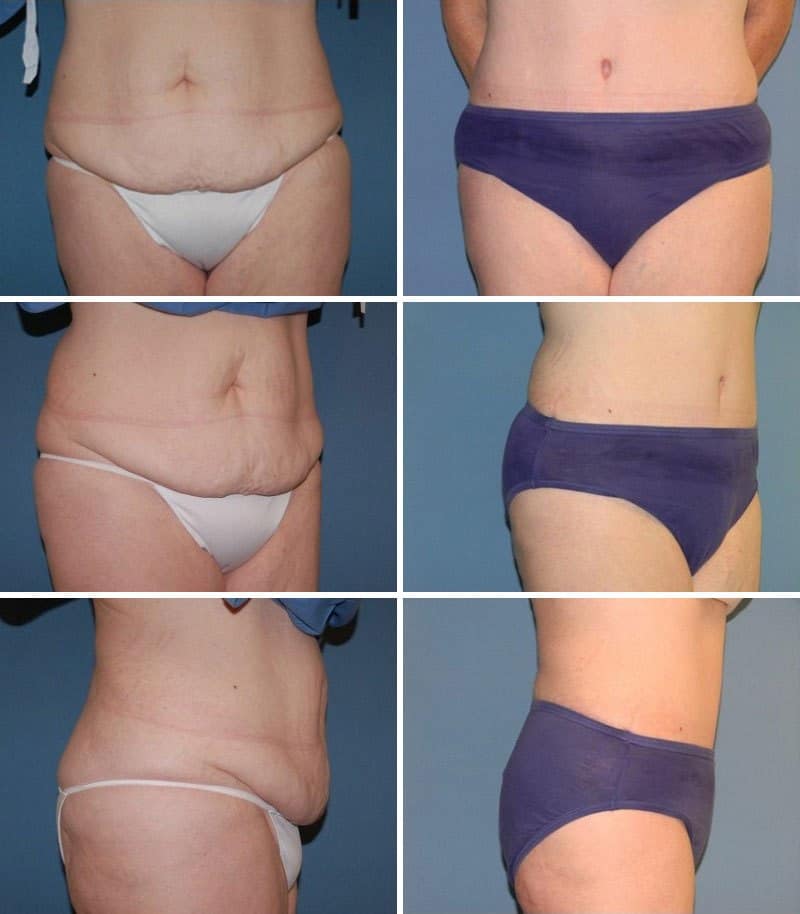 tummy tuck before after san diego