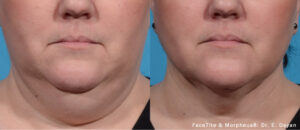 Facetite San Diego Chin