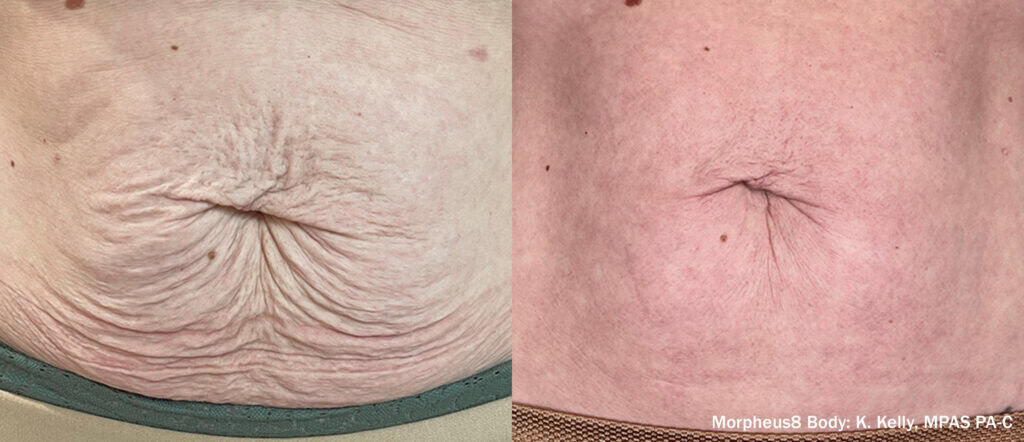 Morpheus8 Body Before After