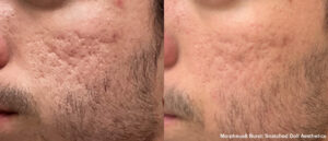 Morpheus8 San Diego Before After Acne Scars