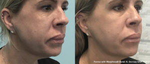 Morpheus8 San Diego Before After Face
