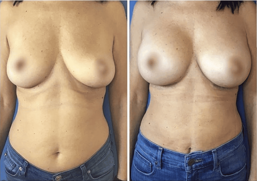 breast augmentation San Diego