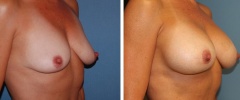 breast-augmentation-p1-o