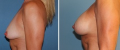 breast-augmentation-p1-s