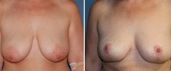 breast-lift-3