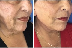 Lower_face_neck_lift