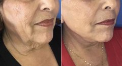 facial-rejuvenation-patient4