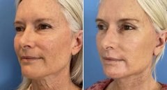 facial-rejuvenation-patient5