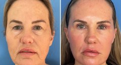 facial-rejuvenation-patient6