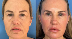 facial-rejuvenation-patient7