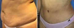 lipo-tummy-tuck-patient