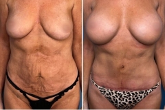 mommy-makeover-patient8