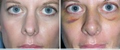 rhinoplasty-03