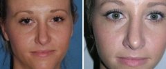 rhinoplasty-04