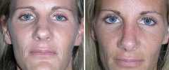 rhinoplasty-05