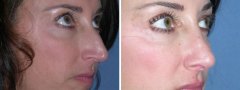 rhinoplasty-08