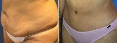 lipo-tummy-tuck-patient