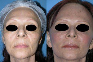 Skin resurfacing before and after in san diego