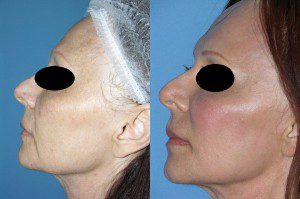 laser skin resurfacing before and after in san diego