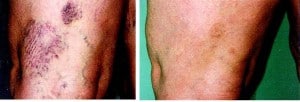 broken capillaries treatment san diego