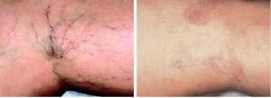 rosacea skin treatment san diego