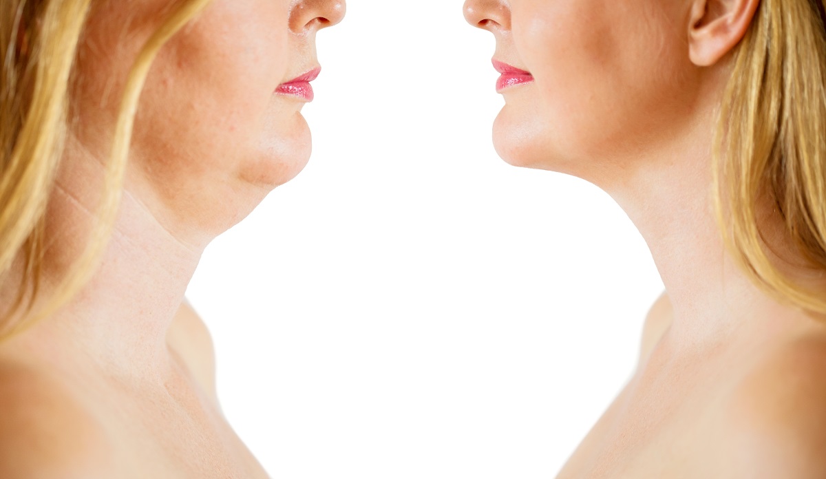 Neck Lift in San Diego & La Jolla