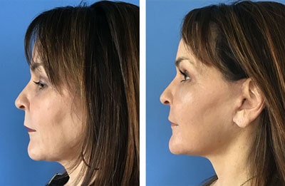 Facial Rejuvenation patient before & after photos