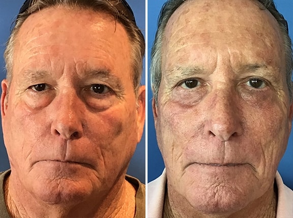 Male Blepharoplasty Patient Photos in San Diego & La Jolla