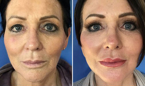 Facial Rejuvenation Before & After San Diego & La Jolla