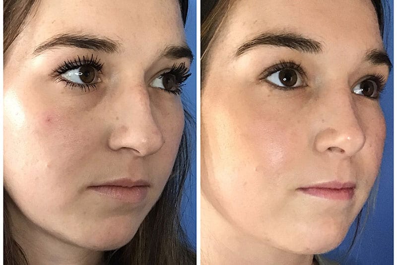 Nose Surgery Patient Before After Photos in San Diego & La Jolla