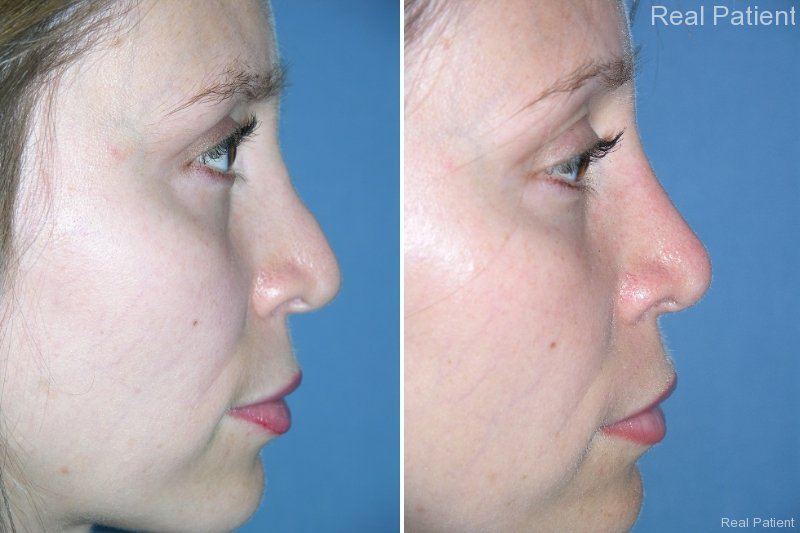 Rhinoplasty Patient Before After Photos in San Diego