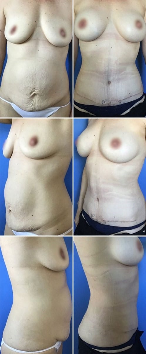 Mommy Makeover Before and After Patient in San Diego