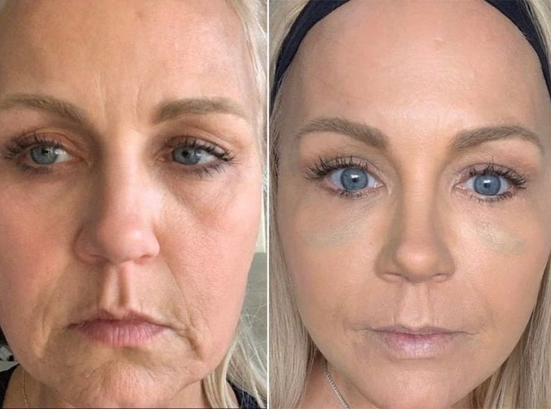 Facial Rejuvenation Treatment Before & After San Diego & La Jolla