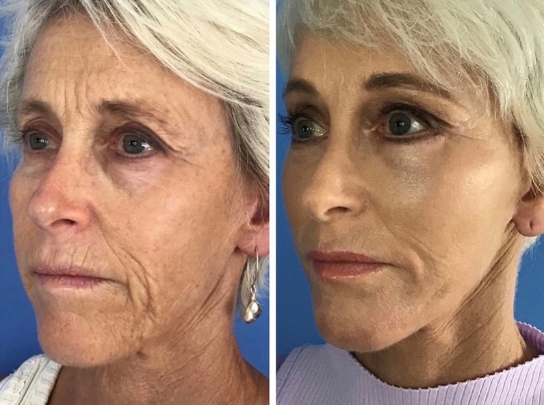 Facial Rejuvenation Treatment Before & After in San Diego