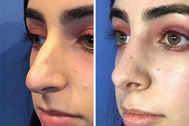 Rhinoplasty Before & After in San Diego & La Jolla