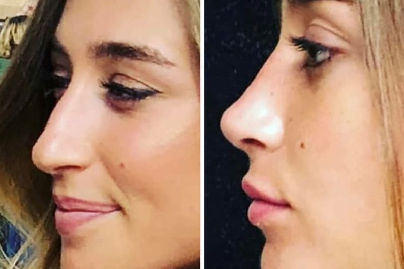 Nose Surgery Before & After in San Diego