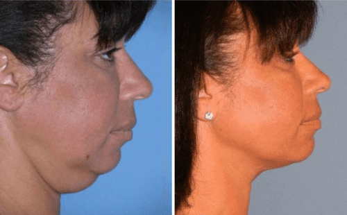 Facial Liposuction before and after in San Diego